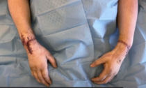38enne si amputa entrambe le mani sul lavoro, riattaccate grazie a un rarissimo intervento chirurgico